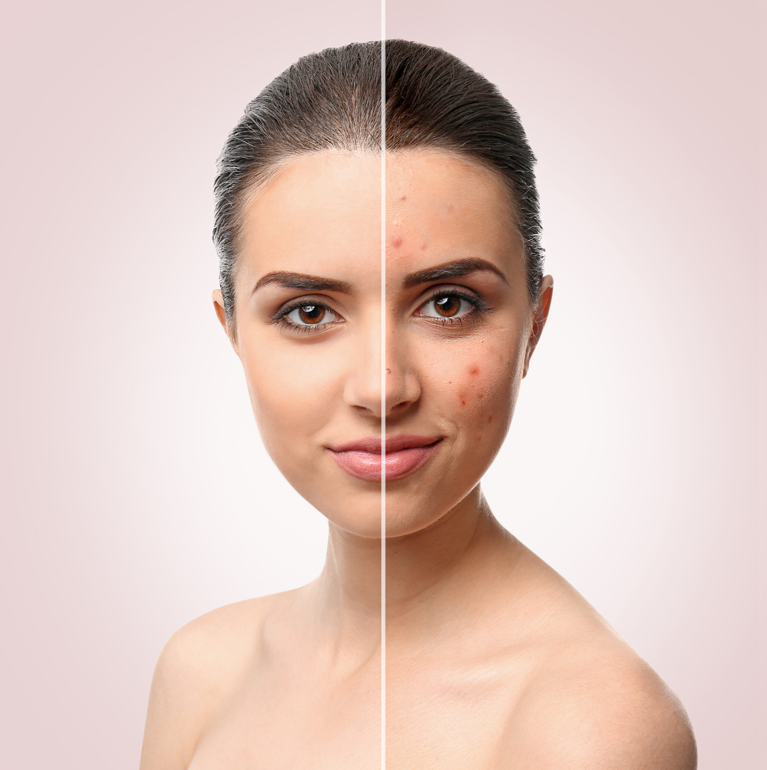 Acne Awareness Month: Understanding the Impact of Diet, Environment, and Hormones on Your Skin